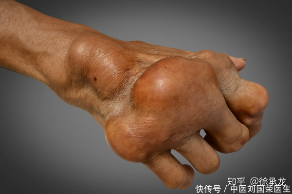 牛顺网 新研究：风湿关节炎病人单用雪上一枝蒿片（口服），显著缓解疼痛